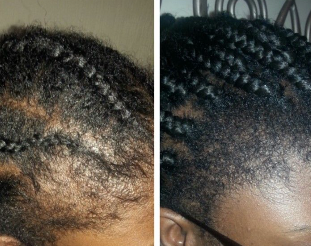 Aloura™ Hair Growth Accelerator Gummies